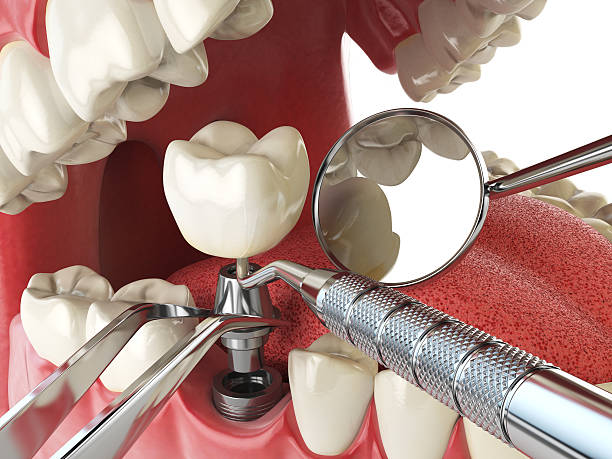Best Emergency Tooth Extraction in Maryland City, MD